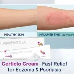 Certiclo Cream for Eczema & Psoriasis: Fast Relief with Clobetasol Propionate 0.05%