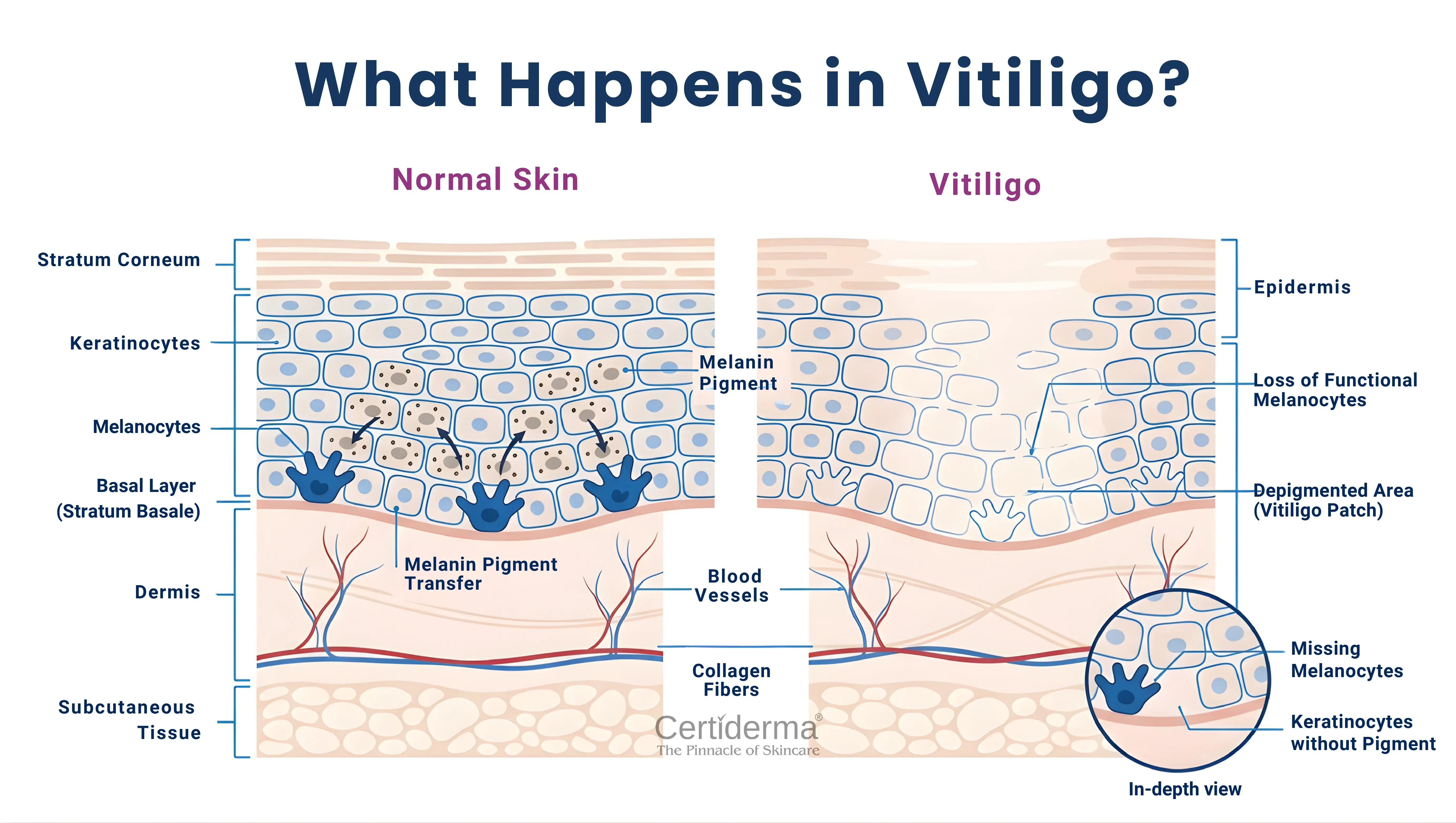 certiderma-vitiligo-melanocyte-loss-skin-diagram-depigmentation-explained