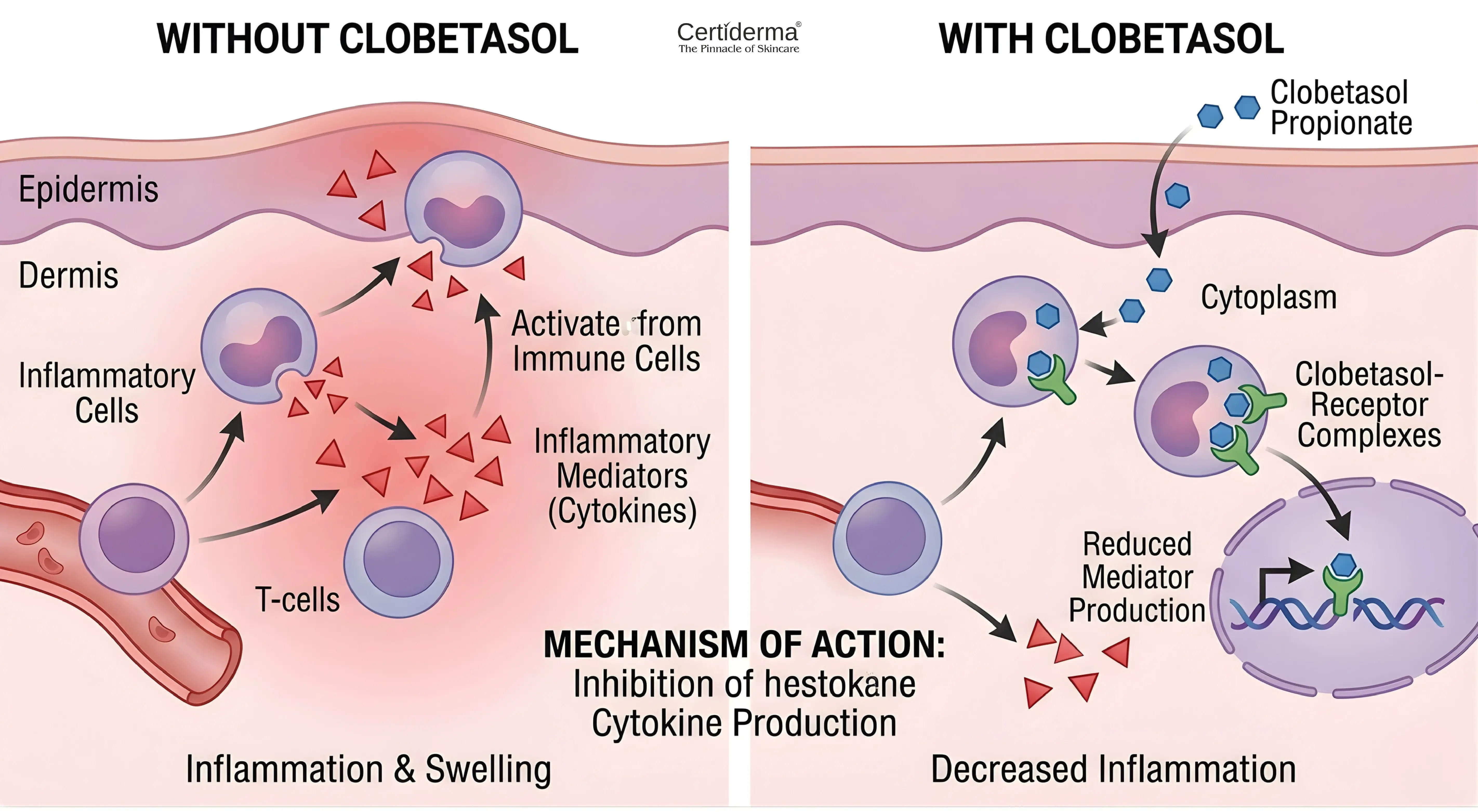 Diagram showing how Clobetasol Propionate reduces skin inflammation and cytokine production image by Certiderma